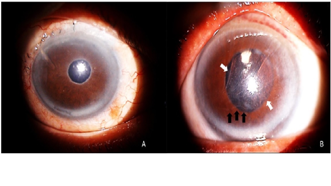 Anterior segment photos showing (A) right eye clear cornea, presence of pseudoexfoliative materials over the pupillary margin, a surgical peripheral iridectomy and a flat conjunctival bleb indicating a failed trabeculectomy, with no sign of vortex keratopathy as compared to (B) whorl-like opacities (white arrows) merging into a horizontal line (black arrows) in the left eye which was very characteristic of vortex keratopathy