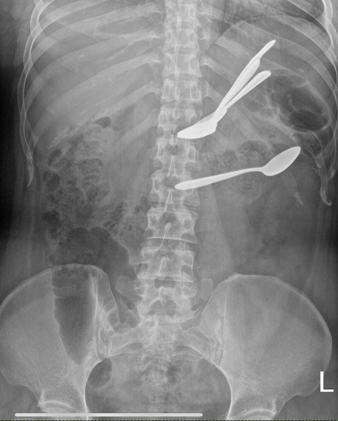 Foreign bodies in the stomach and transverse colon on abdominal X-ray