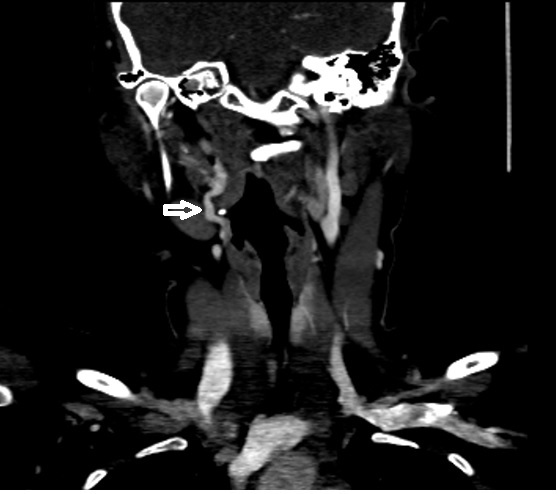 CTA showing tortuosity of right extracranial ICA at level C2 (white arrow)