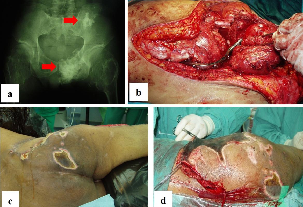 FIGURE 1: In Case #2, the patient had recurrence of left pelvic chondrosarcoma. Plain radiograph showed involvement of the ischiopubic region and ilium, indicated by the red arrows; (a) This led to the decision for an internal hemipelvectomy with hip arthrodesis using plate and screws; (b) However, he subsequently developed chronic wound infections and dehiscence, necessitating multiple debridement; (c & d) which eventually resulted in the decision for an external hemipelvectomy
