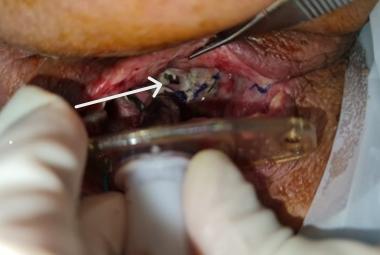 Tracheal dehiscence (white arrow) and surrounding slough just above the tracheostomy tube.