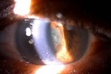 Anterior segment of the left eye with keratic precipitates, seclusio pupillae and dense cataracts