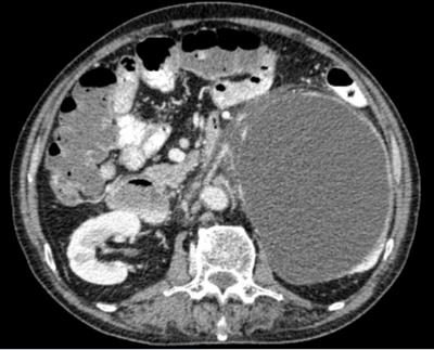 Figure 1: Contrasted computed tomography showing left huge homogenous and regular retroperitoneal lesion with peripheral enhancement on axial view