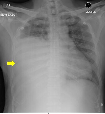 Figure 1: Chest X-ray showed the opacities of the right mid and lower zone (yellow arrow) with trachea deviated to the left.